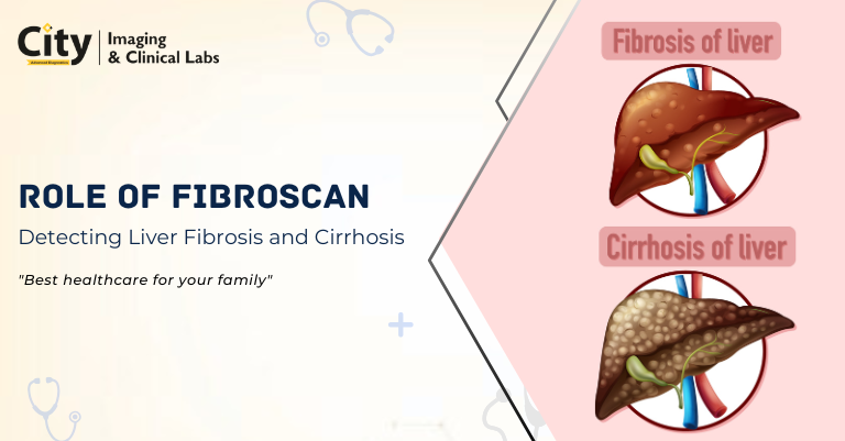 Role of FibroScan in Detecting Liver Fibrosis and Cirrhosis